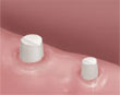 dental bridge procedure - preparing teeth around space - colgate au