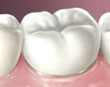 porcelain crown - colgate au