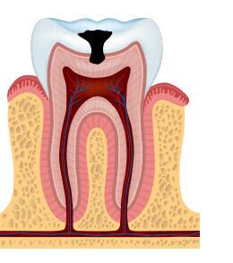 stages of tooth dentin decay pictures - colgate au