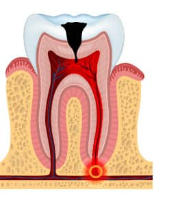 pulp involvement - cavity stages - colgate au