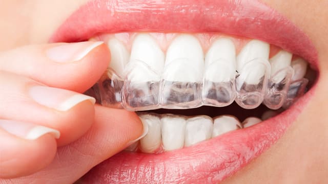 how custom teeth whitening trays work - colgate australia