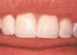 after teeth bonding picture - colgate au