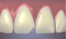 Chipped Tooth