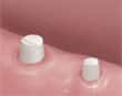 dental bridge procedure - preparing teeth around space - colgate au