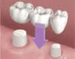 dental bridge - colgate au
