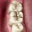 gold dental filling - colgate au