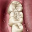 white dental filling - colgate au