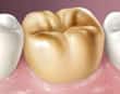 gold crown tooth - colgate au
