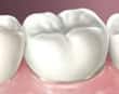 porcelain crown - colgate au