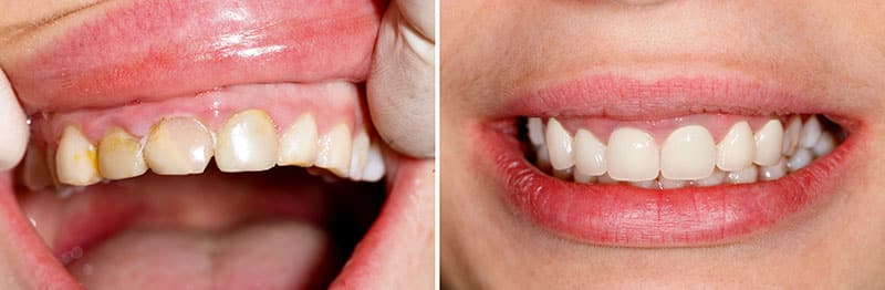 teeth before and after the installation of porcelain crowns