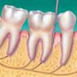 Periodontis