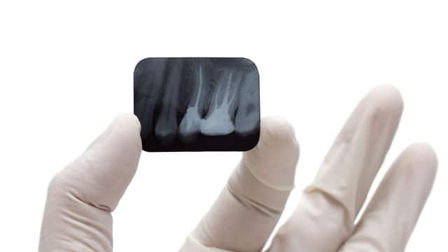 Xray of teeth